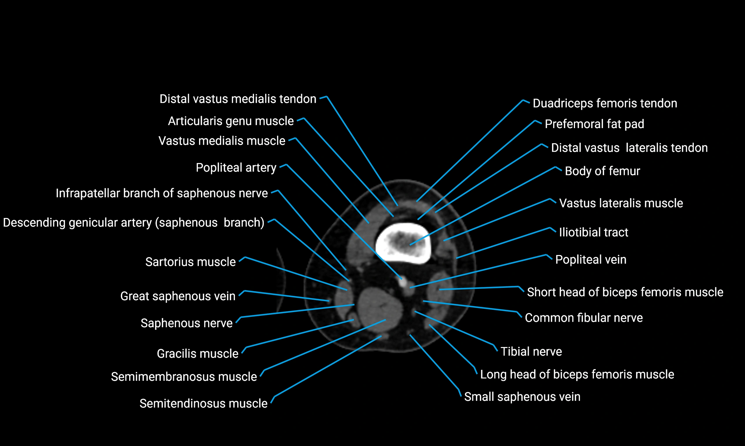 CT thigh axial cross sectional anatomy labelled image_77 (2).webp